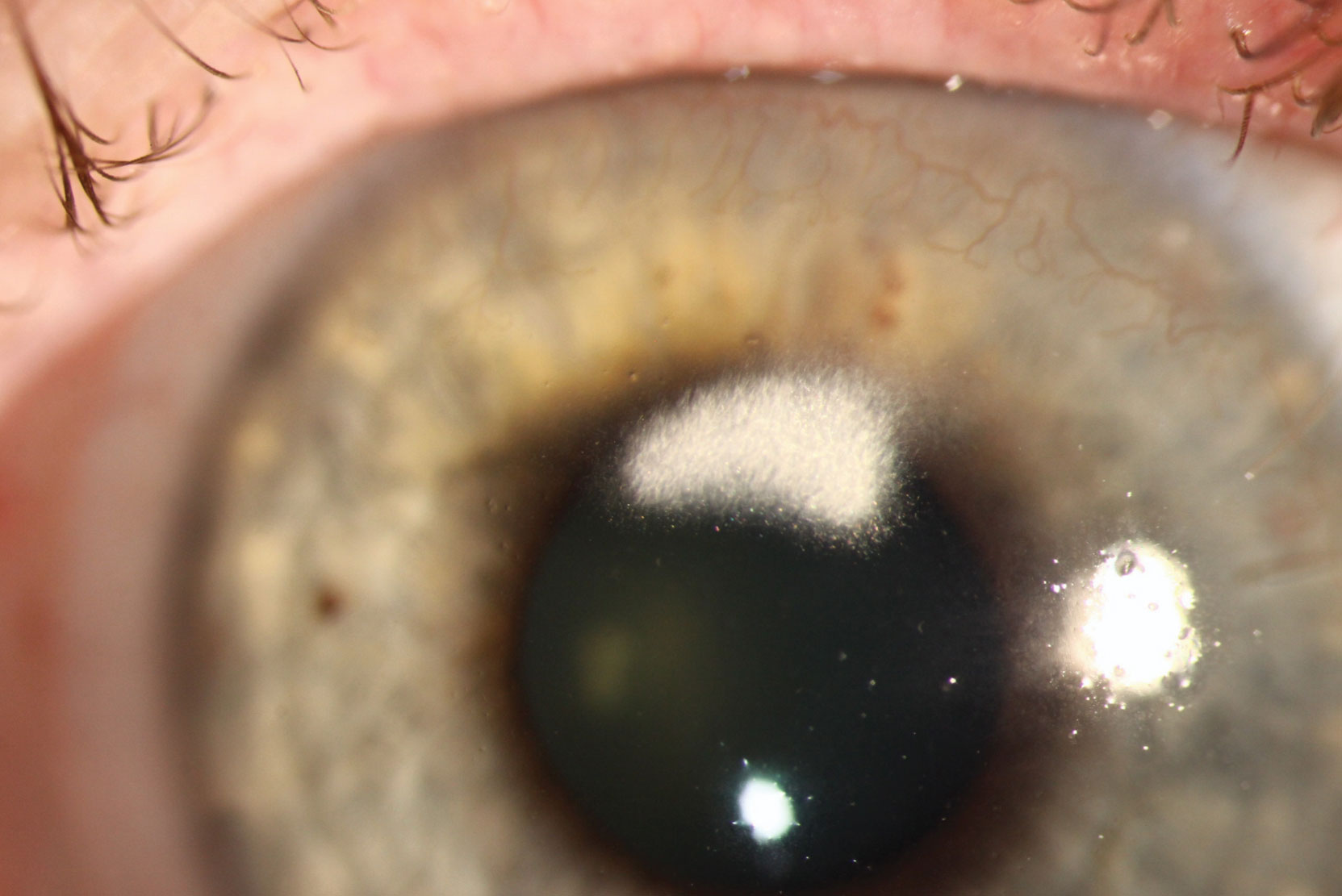 Feathery-looking corneal scars are a common response to infections, injuries and surgeries. 
